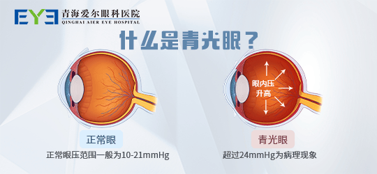 青海爱尔：青光眼这种“视力窃贼”是怎么产生的呢